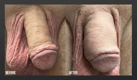 Male enhancement penis enlargement before and after comparison