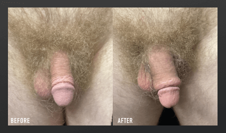 Male enhancement penis enlargement before and after comparison