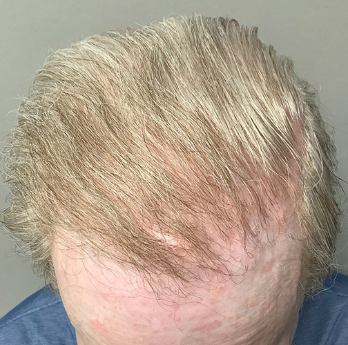 After FUE Hair Transplant